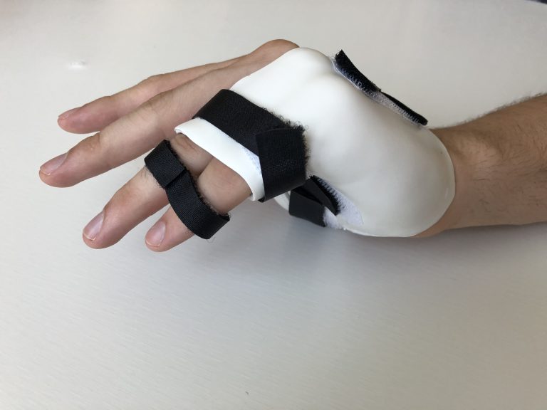 Orth se Pour Fracture Des M tacarpiens Institut D appareillage orth-se-pour-fracture-des-m-tacarpiens-institut-d-appareillage